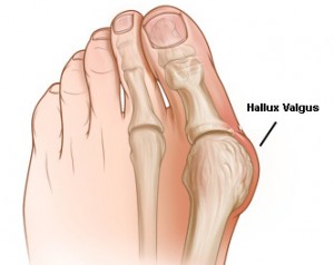 hallux valgus radiology